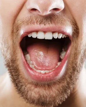 Oral Microbiome